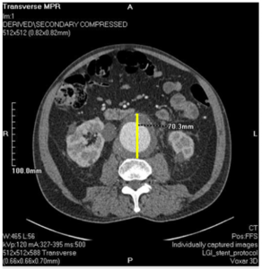 CT aortogram shows a rapid increased 7.0 cm (yellow line) size of the AAA in the anteroposterior diameter. This also shows sign of impending rupture and beak in left lateral aortic thrombus.