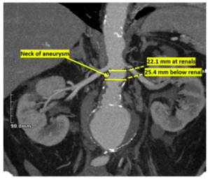 Coronal CT angiogram image shows 7.0 cm aneurysm. The diameter of the neck of aneurysm at the renal arteries were 22.1 mm and the renal arteries below were 25.4 mm.