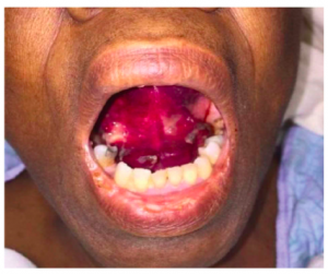 mouth photo of patient.