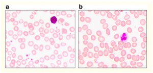 blood smear image of the patient