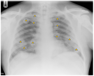 Chest X-Ray Images