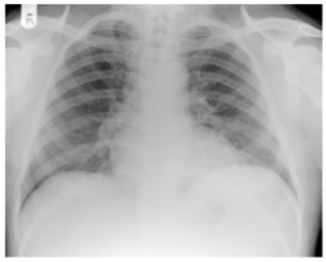 Chest X-Ray from routine follow-up showing no metastases six weeks after operation