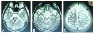High signal intensity lesions on T2WI of MRI images