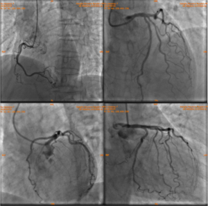 coronary angiography images