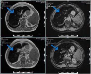 Figure 2. MRI of the liver in hereditary hemochromatosis showing (blue arrow) uniformly low T1 and T2 signal intensities, indicative of iron overload (“black liver” appearance).