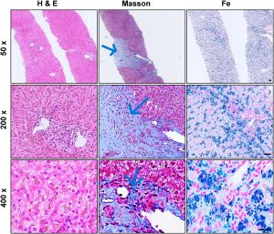Figure 3. Liver biopsy histopathology in hereditary hemochromatosis. H&E-stained sections (left) show preserved hepatic lobular architecture with numerous tan pigment granules in hepatocyte cytoplasm. Masson-stained sections (center) demonstrate subcutaneous fibrosis in the central vein and occasional bridging fibrosis. Prussian blue-stained sections (right) reveal grade 4+ iron deposition in hepatocytes with sparse iron in Kupffer cells and plasma cells. Scale bars: 50×, 5 μm; 200×, 20 μm; 400×, 40 μm.