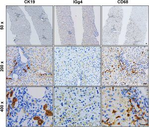 Figure 4. Immunohistochemical analysis of liver biopsy in a patient with hereditary hemochromatosis. CK19-positive cholangiocytes and IgG4-positive cells indicate inflammation and fibrosis resulting from iron deposition in hepatocytes. Numerous lymphocytes, plasma cells, IgG4-secreting plasma cells, and activated Kupffer cells are also observed. Scale bars: 50×, 5 μm; 200×, 20 μm; 400×, 40 μm.