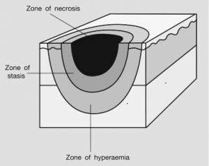 Jackson Zones of Burn Injury