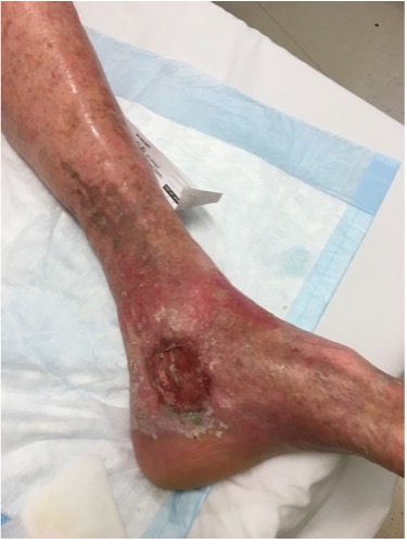 Picture of Venous ulcer
