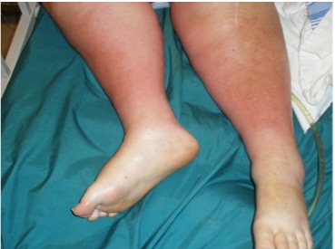 Picture of Acute Lipodermatosclerosis (LDS)