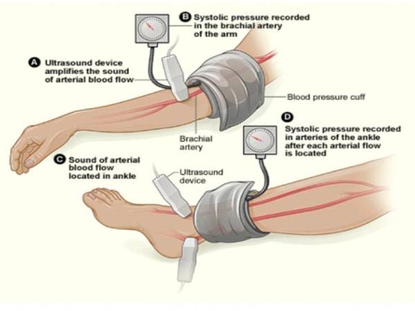 How to Perform an ABPI