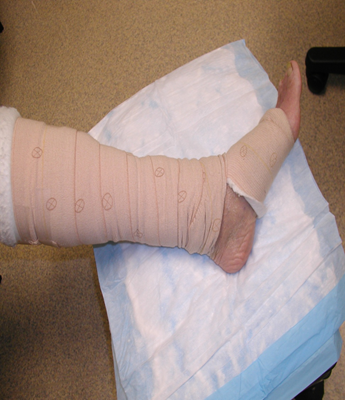 Photo showing incorrect application of compression bandage
