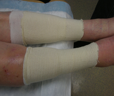 Photo showing incorrect application of compression bandage
