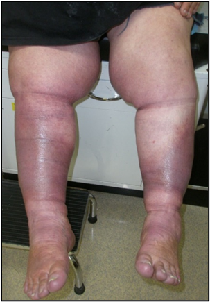 hoto showing misshaping of legs due to long term incorrect application of compression bandages.