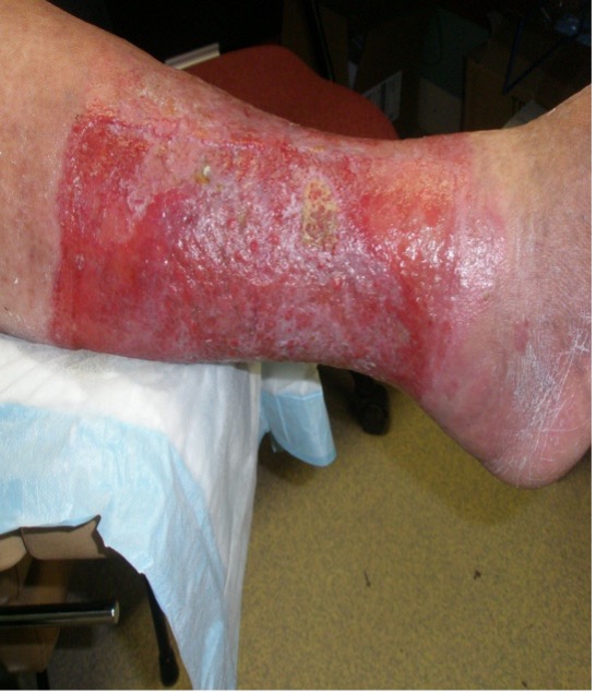 Stasis Dermatitis with erosions (loss of Epidermis with Epidermal base)
