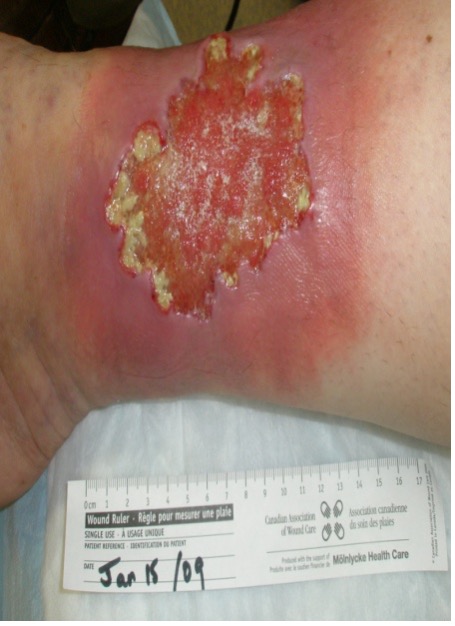 Cellulitis with Ulcer (loss of Epidermis with a dermal or deeper base)