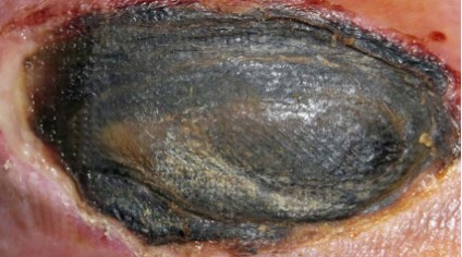 This picture illustrates a hard black eschar on the heel of a foot]