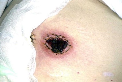 Necrotic stoma