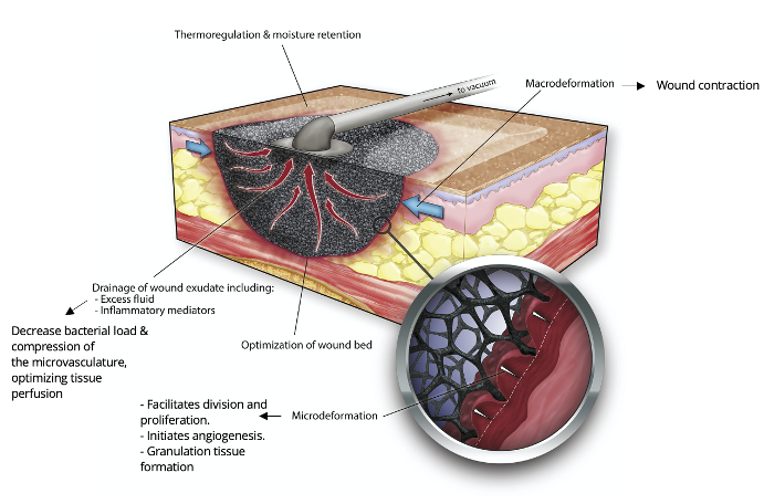 Negative Pressure Wound Therapy