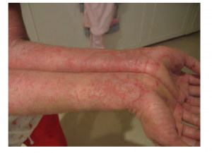 Person with eczema on their forearms.