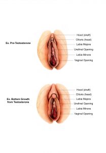 Clitoris pre and post testosterone therapy