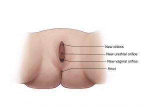 Example of Male to Female post surgery, labeled.