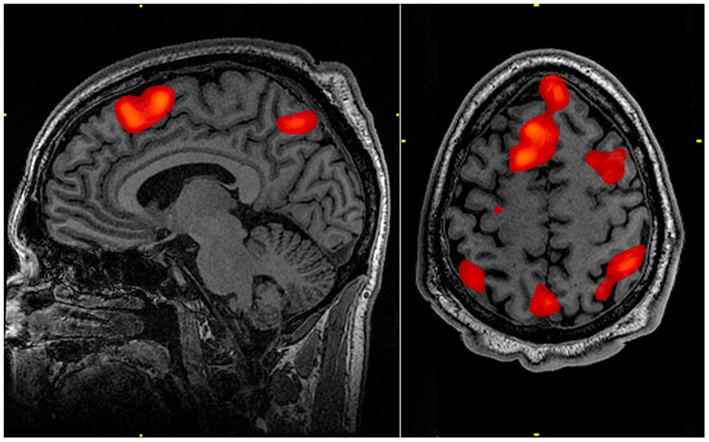 A scan of a human brain. Some sections of the brain are lit up in red.