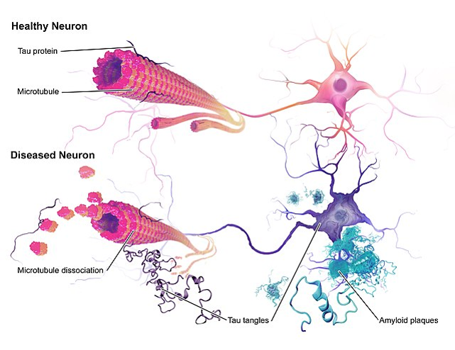 A diagram showing healthy neurons vs diseased neurons.
