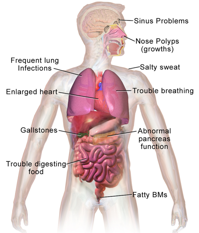 The symptoms of cystic fibrosis include: sinus problems, nose polyps, frequent lung infections, salty sweat, enlarged heart, trouble breathing, gallstones, abnormal pancreas function, trouble digesting food, and fatty BMs.