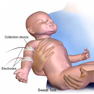 A medical image that depicts how a chloride sweat test is performed in a baby.