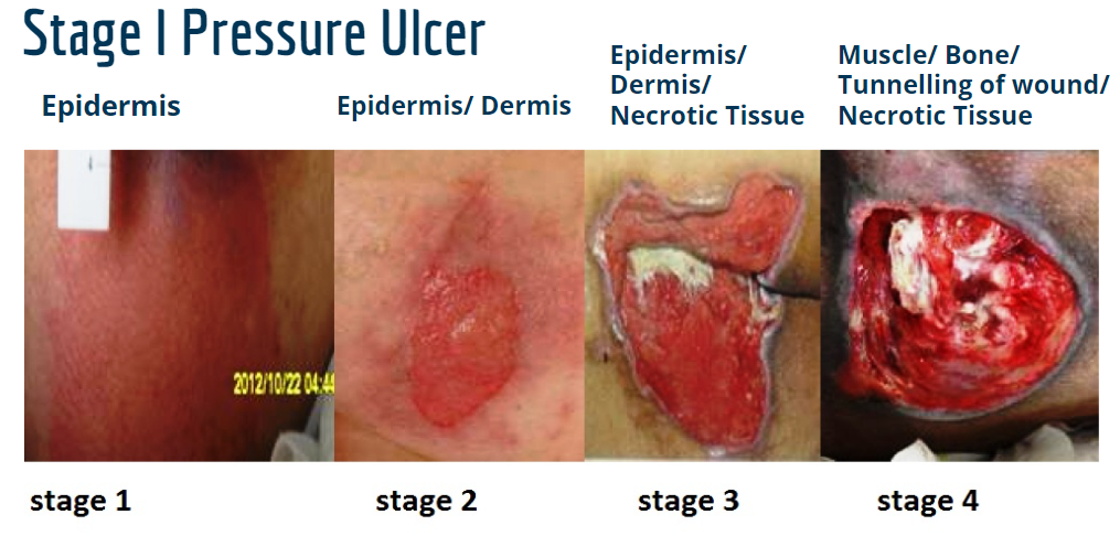Illustrates the different stages of wound during pressure ulcer. Chronic ulcer of skin where the ulcer is an ulceration of tissue deprived of adequate blood supply by prolonged pressure.