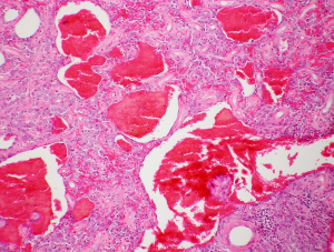 Image shows liver tissues with cancer cells in a microscopic view.