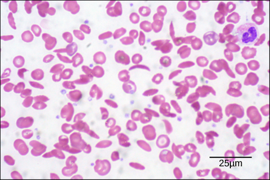 Figure 20.21.  Individuals with sickle cell anemia have crescent-shaped red blood cells. (credit: modification of work by Ed Uthman; scale-bar data from Matt Russell)