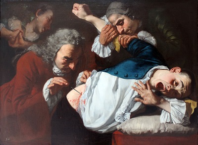 A painting showing the pain in ones face while undergoing an operation without antiseptics.