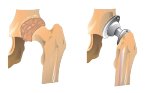 Polymers can be used in joint replacement. The image shows the use of a synthetic polymer to replace part of the ball and socket hip joint.