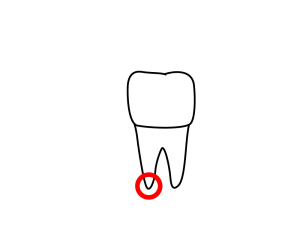 Line drawing of molar with red circle on tip of one root.