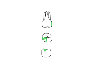 Line drawing of three views of molar from dental chart, with section of green shading on surface.
