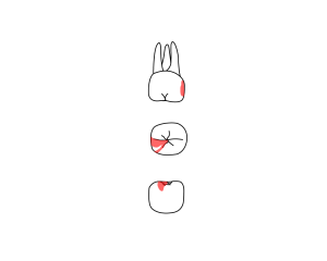 Line drawing of three views of molar from dental chart, with section of red shading on surface.