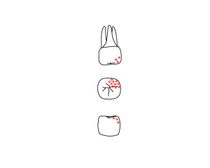 Line drawing of three views of molar from dental chart, with section of red dots on surface.