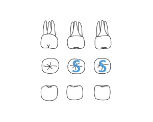 Line drawing of three views of three molars from dental chart, with letter S noted on two molar's occlusal view.