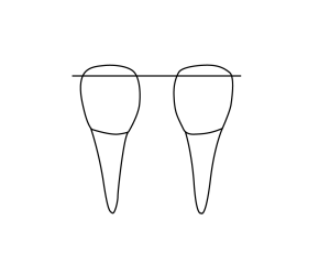 Line drawing of two teeth connected by single lines across the top of the crown.