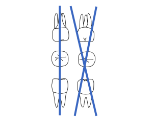 Line drawing of two teeth on dental chart with three views; a vertical blue line is drawn through the tooth views on left and two crossed blue lines are drawn through tooth views on right.