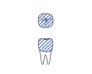 Line drawing of tooth on dental chart with the crown filled in by blue horizontal lines