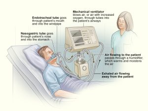 The illustration shows a standard setup for a mechanical ventilator in a hospital room. The ventilator pushes warm, moist air (or air with extra oxygen) to the patient through a breathing tube (also called an endotracheal tube) or a tightly fitting mask.