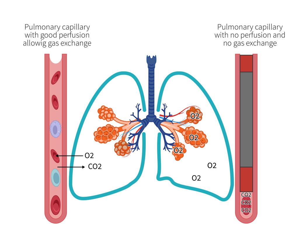 7.2 Why Do We Need Mechanical Ventilation? – Respiratory Failure Type ...