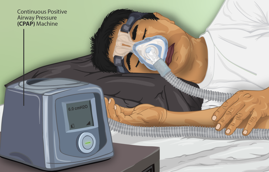 Depiction of a Sleep Apnea patient using a CPAP machine