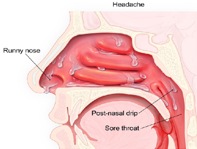 Anatomy of a runny nose.