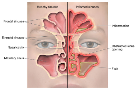 An anatomical view of healthy sinuses next to inflamed sinuses with the differences between the two highlighted.