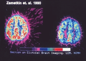 Medical imaging of children's brains; one with ADHD and one without.