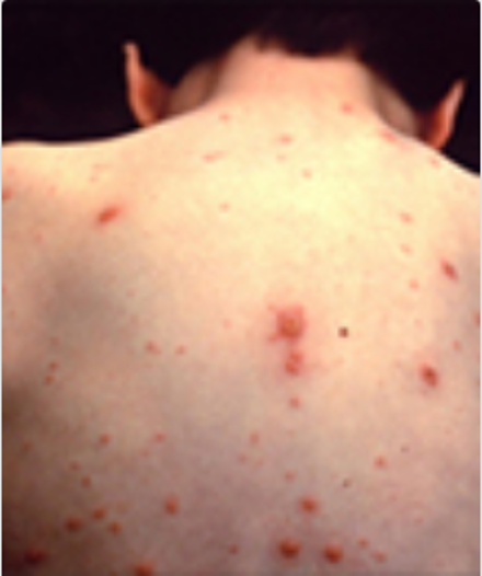 A child's back showing chicken pox.
